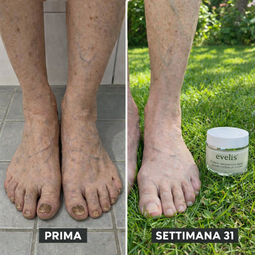 Elimina la micosi delle unghie in modo naturale e duraturo
