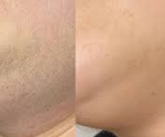 Olio Depilatorio – Specifico per peli da PCOS, per una pelle naturalmente liscia