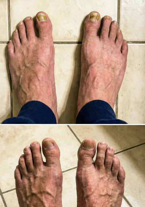 Elimina la micosi delle unghie in modo naturale e duraturo